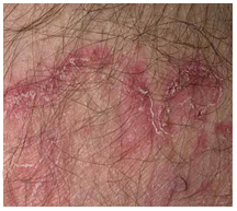 jock itch treatments